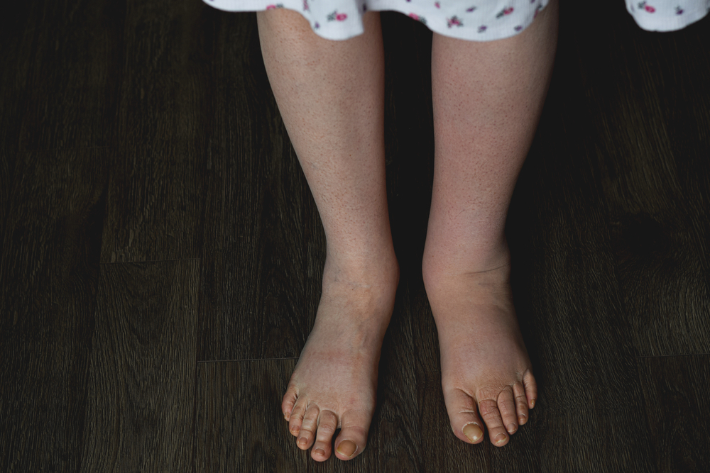 A Guide to Understanding Lymphedema and How to Prevent It | Shaheen Vascular
