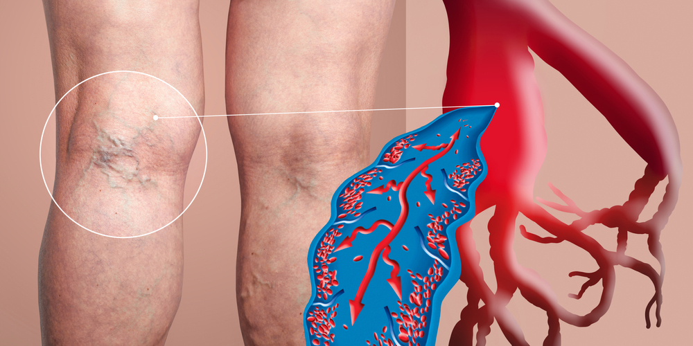 Varicose Veins: Unraveling the Most Successful Treatment Options | Shaheen Vascular