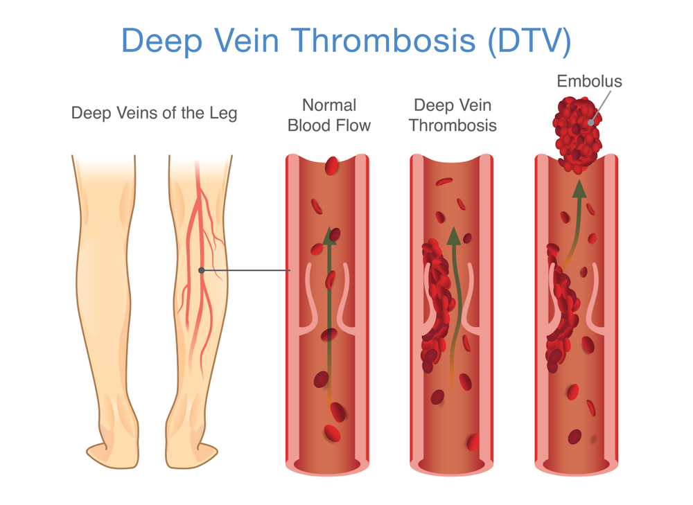 What’s Causing Your Swollen Legs? Exploring Deep Vein Thrombosis | Shaheen Vascular